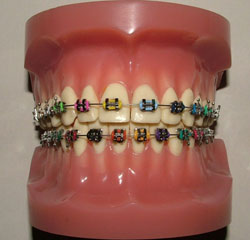 Colored Braces